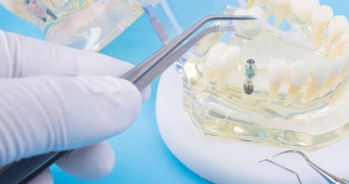 Procedura implantacji zębów w Szczecinie