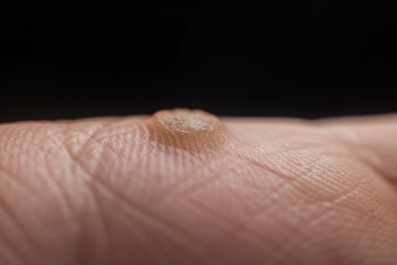 Jak pozbyc sie kurzajki?