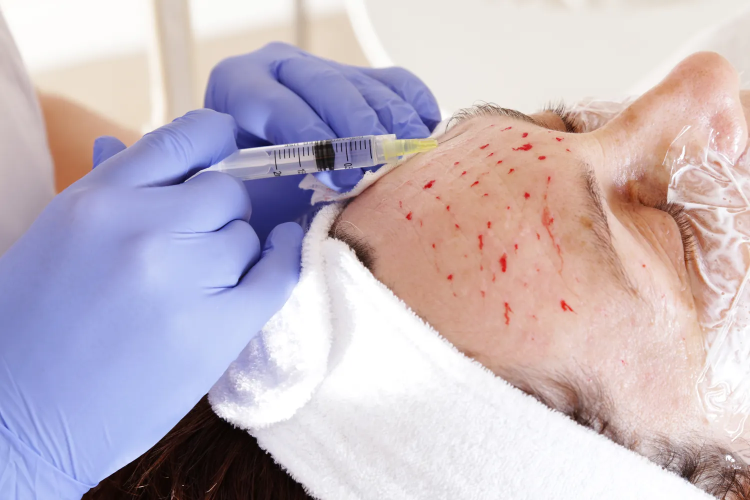 Jak zlikwidować zmarszczki pod oczami medycyna estetyczna?