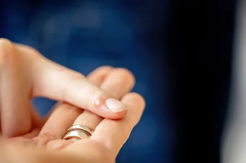 Co na kurzajki stóp?